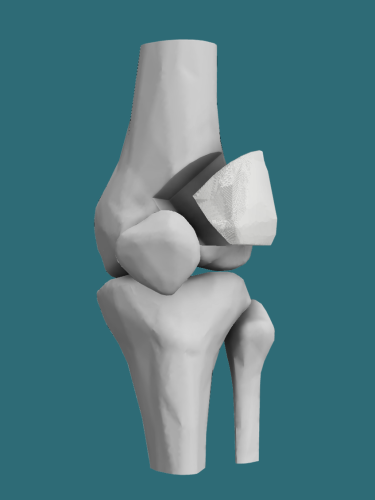 P3D Bone ceramic bone graft substitute patient matched prototype in the distal femur