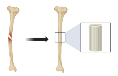 Repair of bone defect with 3D printed implant